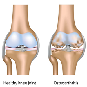 Osteoarthiritis