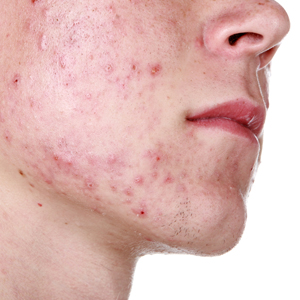 Skin rashes & Allergies