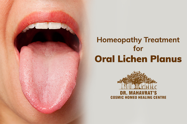 Homeopathy Treatment for Oral Lichen Planus