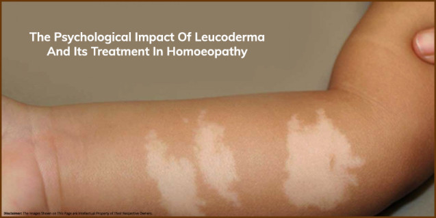 The Psychological Impact of Leukoderma and its Treatment in Homoeopathy