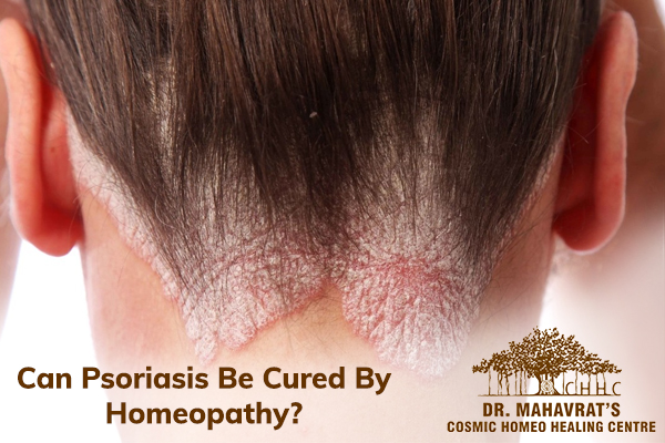 Can Psoriasis Be Cured By Homeopathy?