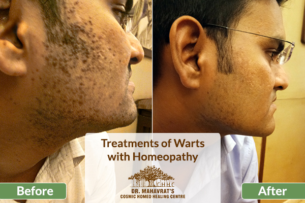 Treatments of Flat Warts with Homeopathy-Chhc